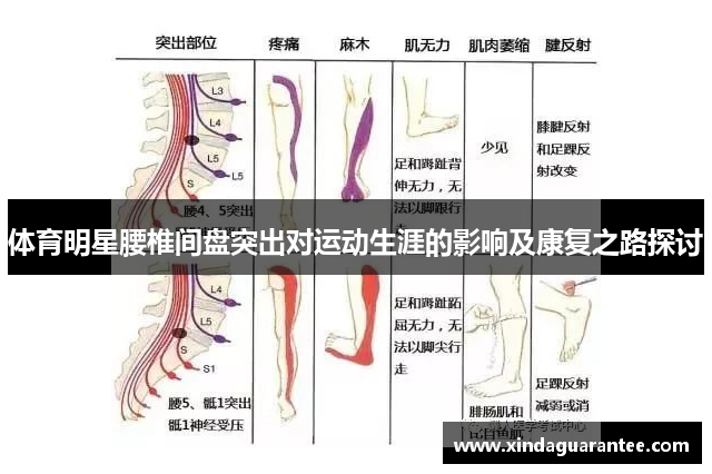 体育明星腰椎间盘突出对运动生涯的影响及康复之路探讨